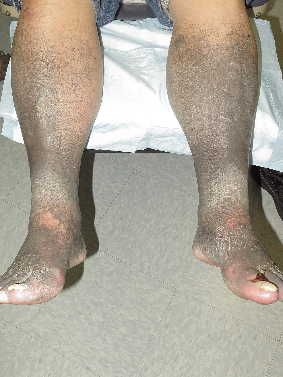 Cureus | A Severe Case of Minocycline-induced Hyperpigmentation of the