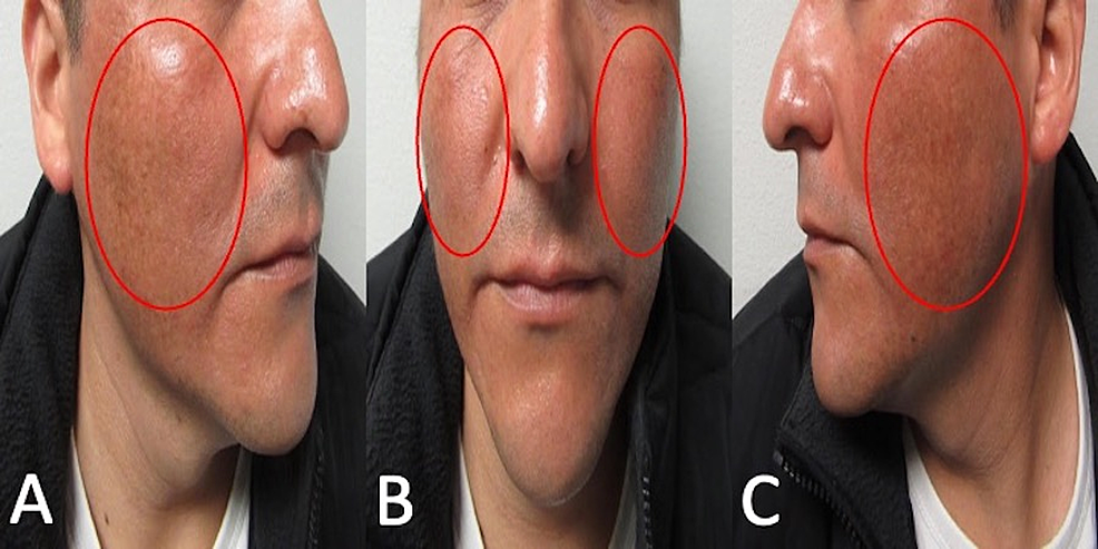 Cureus Doxycycline Associated Hyperpigmentation A Case Report And 