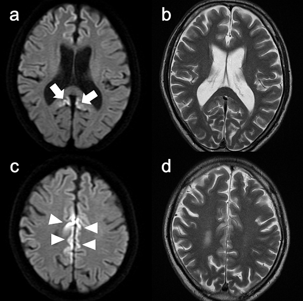 Brain-magnetic-resonance-imaging-(MRI)-findings-at-two-months-before-referral.