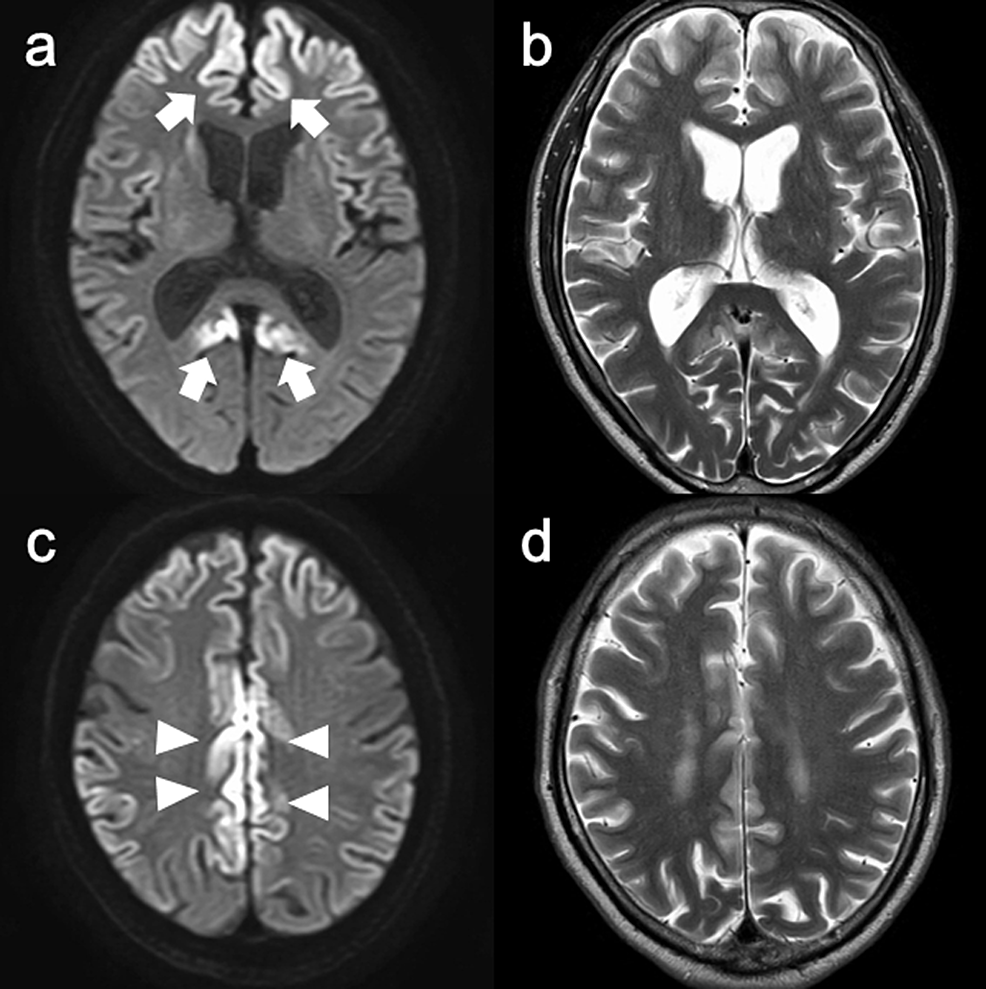 Brain-magnetic-resonance-imaging-(MRI)-findings-at-diagnosis.