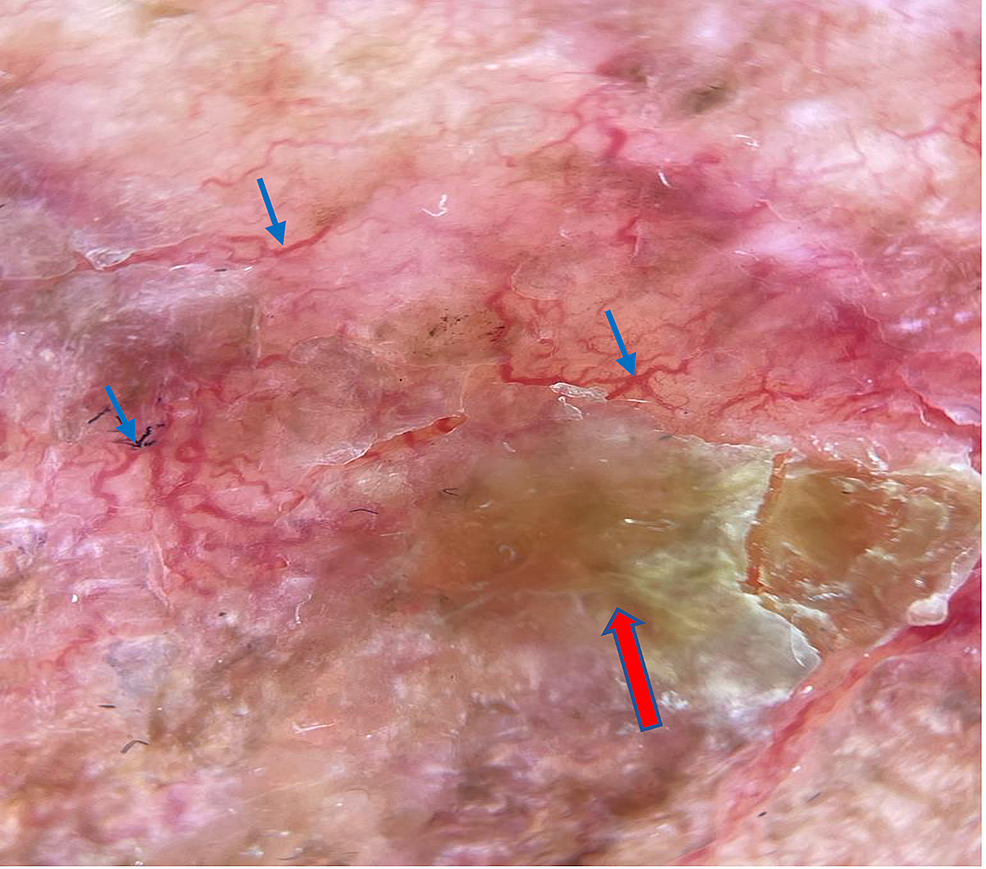 Cureus | Carcinoma Erysipeloides With Clinical and Dermatoscopic ...