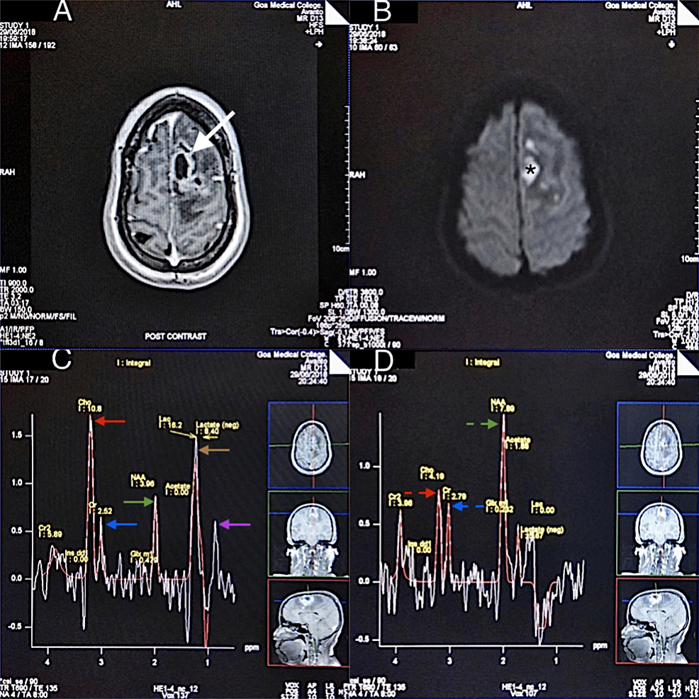 An-MRI-and-MRSI-evaluation-of-a-pyogenic-abscess-case