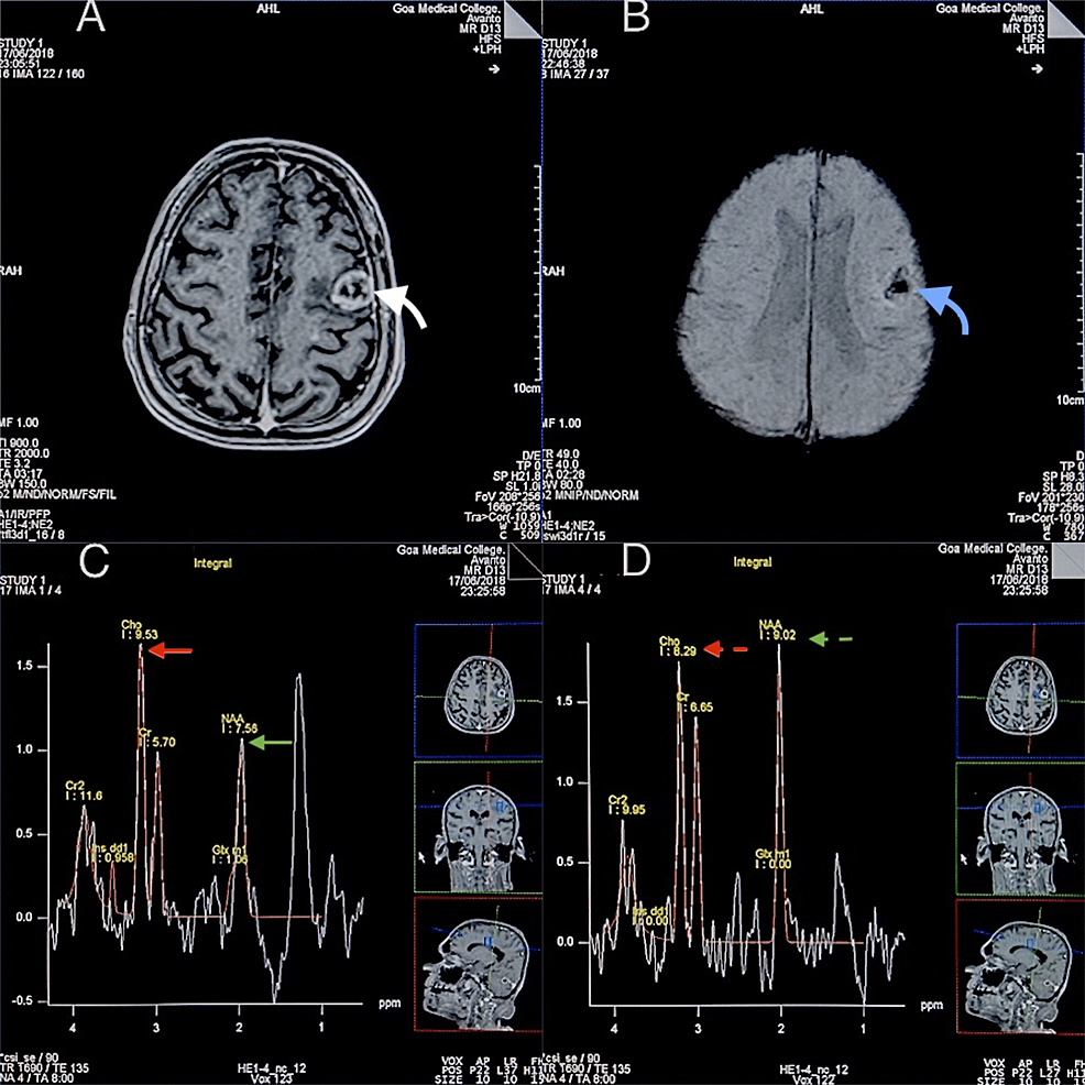 An-MRI-and-MRSI-evaluation-of-a-case-of-metastases-to-the-brain