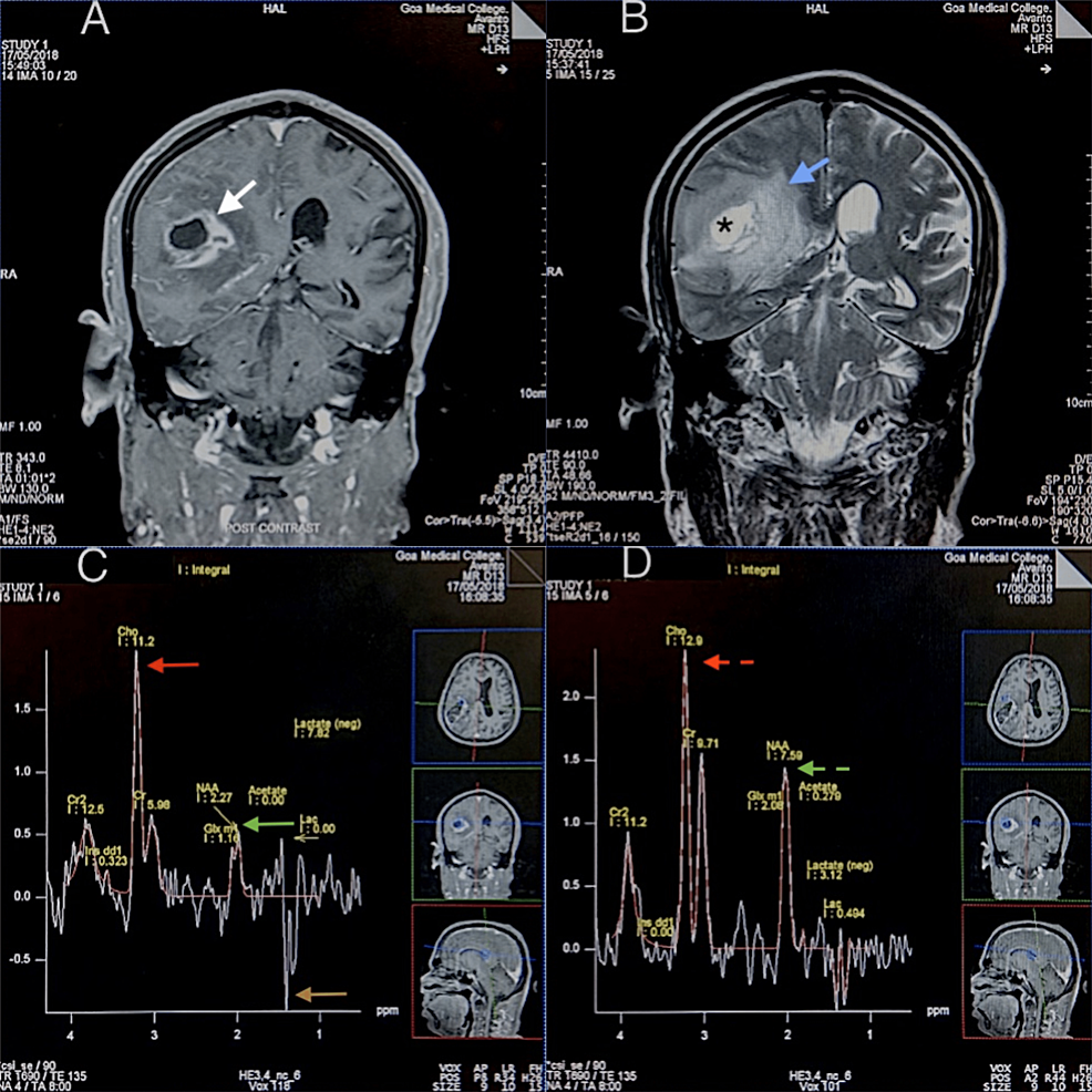 An-MRI-and-MRSI-evaluation-of-a-high-grade-glioma-case