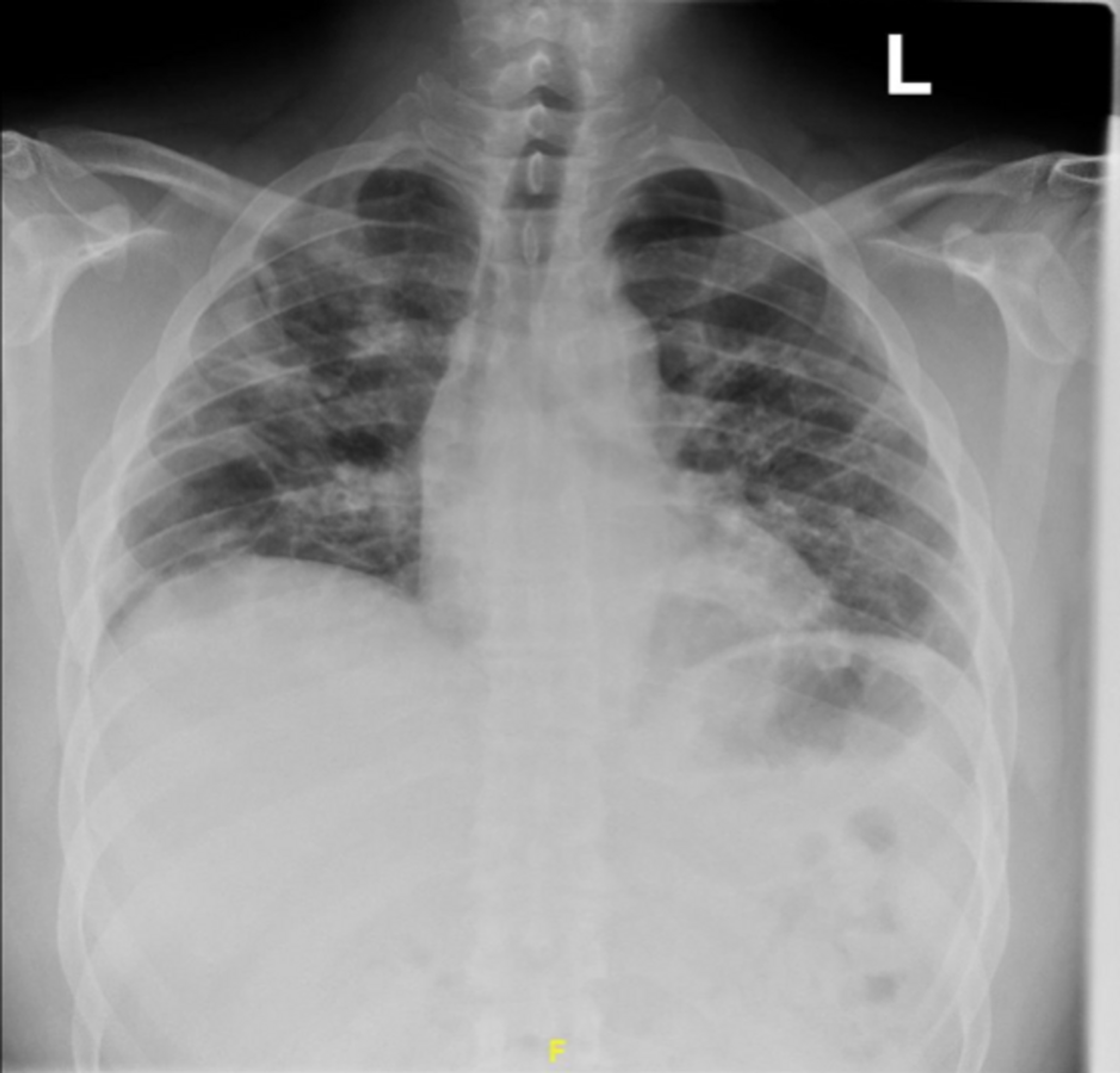 Cureus | Spontaneous Pneumothorax as a Late Complication of Mild COVID ...