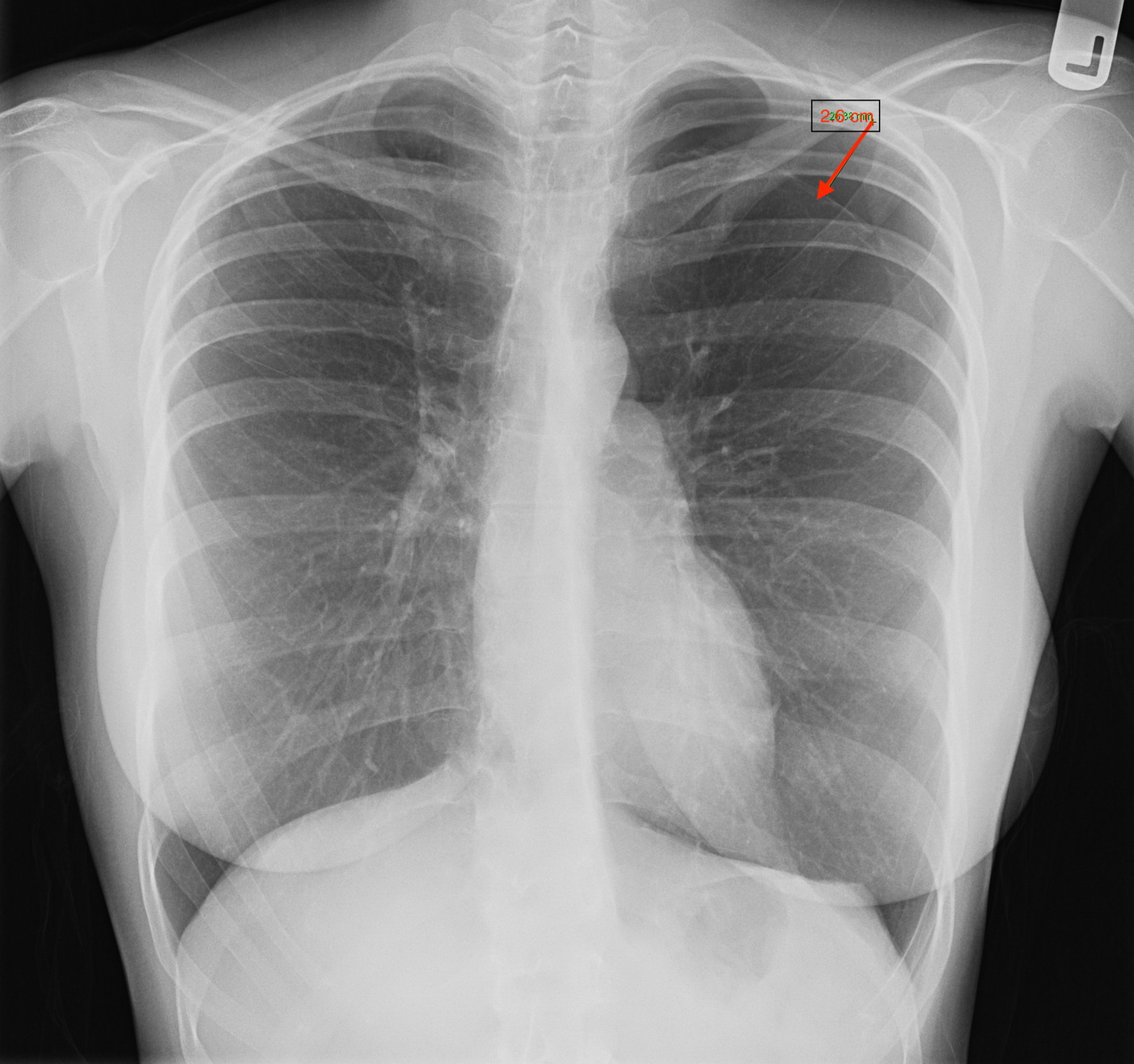 Chest X Ray Posteroanterior View Showing Left Hemo Pneumothorax Images