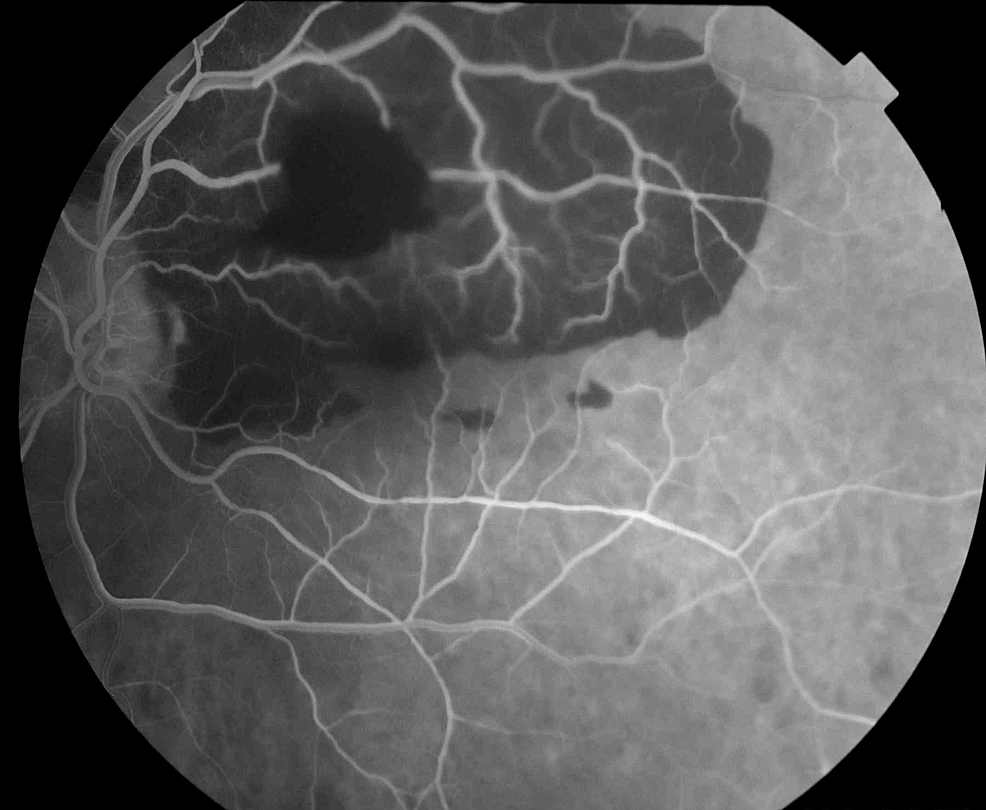 FFA-of-the-left-eye-shows-a-total-blockage-of-the-fluorescein-in-the-supratemporal-quadrant-and-the-macula.