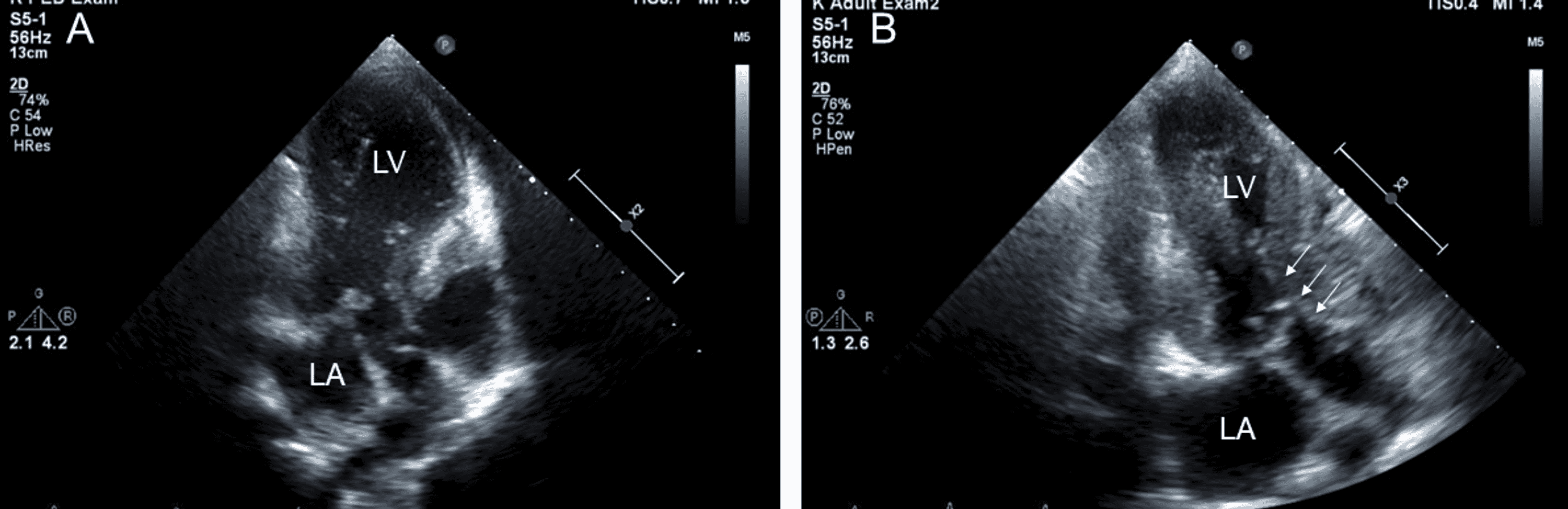 Cureus | Progressive Left Ventricular Outflow Tract Stenosis in a ...