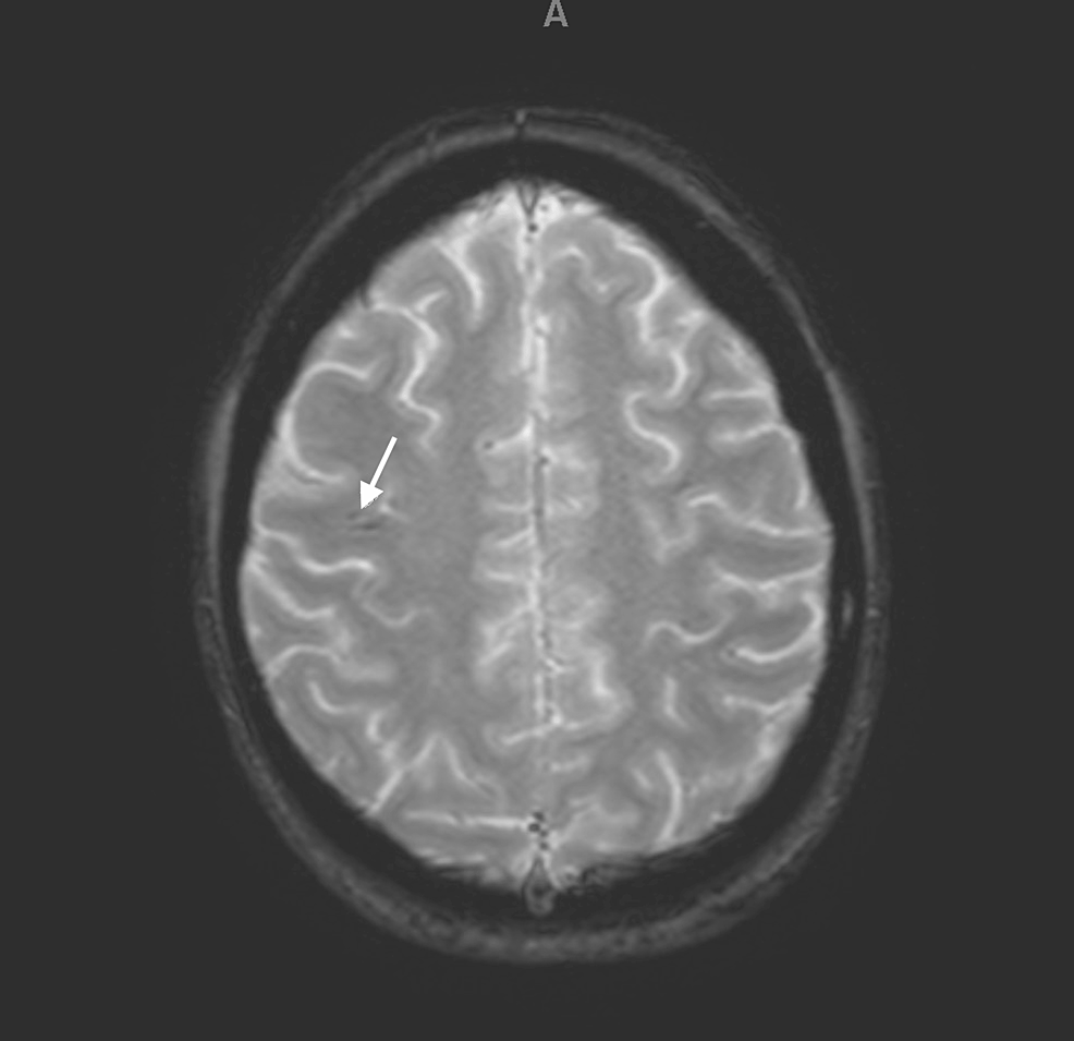 cureus-spontaneous-pulmonary-embolism-leading-to-sudden-cardiac