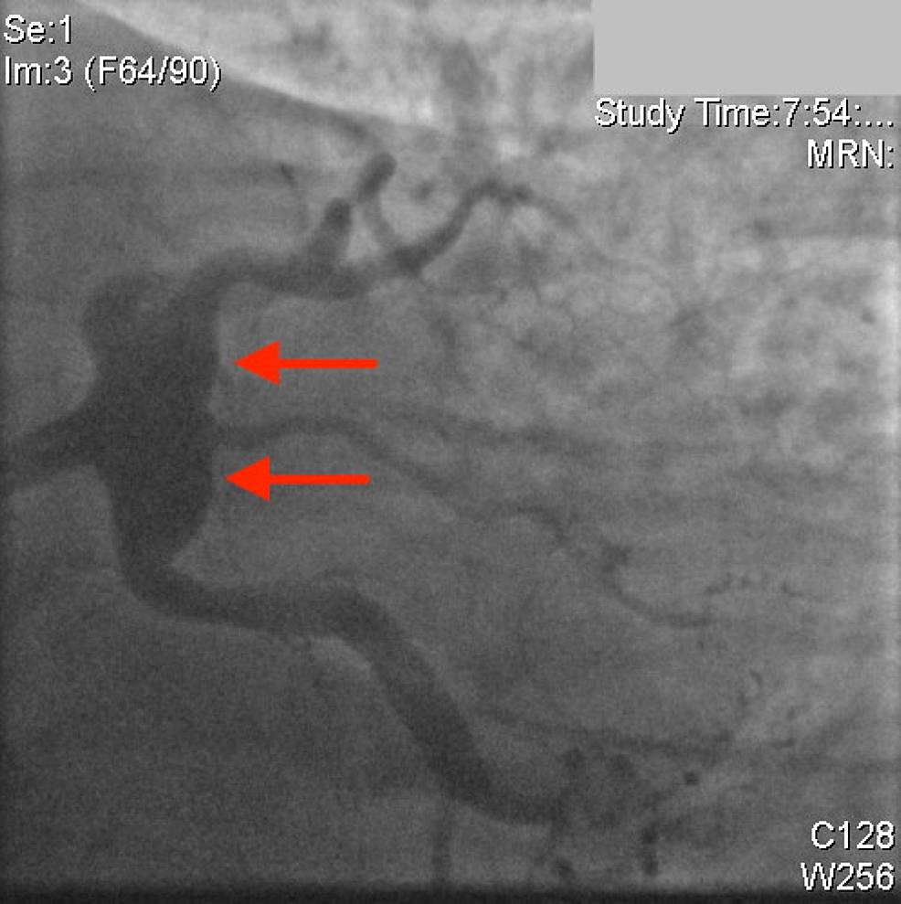 Left-anterior-descending-artery,--left-circumflex-artery,--left-main-artery,--ramus-intermedius