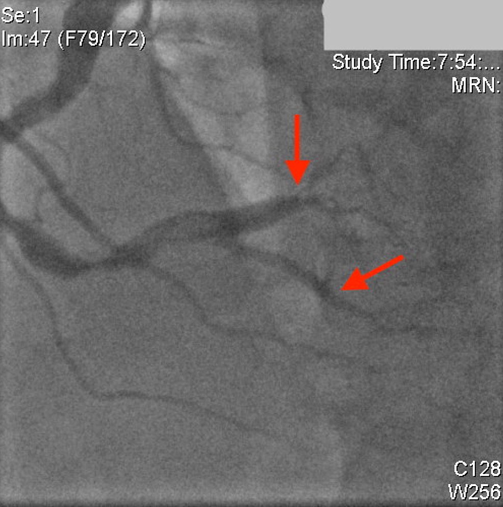 -Right-coronary-artery-with-improved-distal-flow