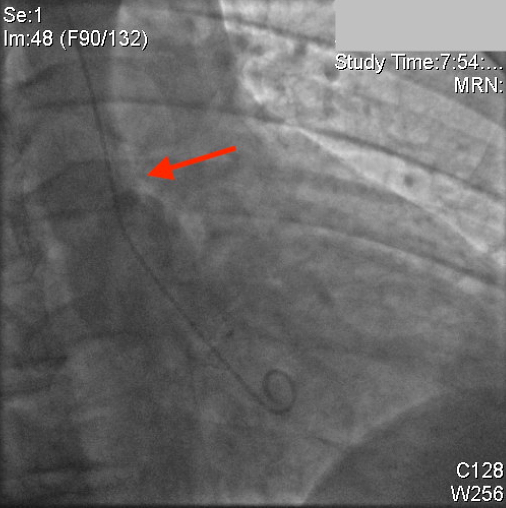 Normal-aortography