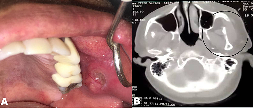 (A)-Clinical-image-showing-a-nodular-cystic-swelling-of-around-2-cm-opposite-to-left-maxillary-second-premolar-and-first-molar-teeth-region-on-the-buccal-mucosa.-(B)-Computed-tomogram-(CT)-scan-showing-normal-maxillary-bone-and-maxillary-antral-areas-with-no-bony-involvement-by-the-tumour-(area-highlighted-by-a-circle).