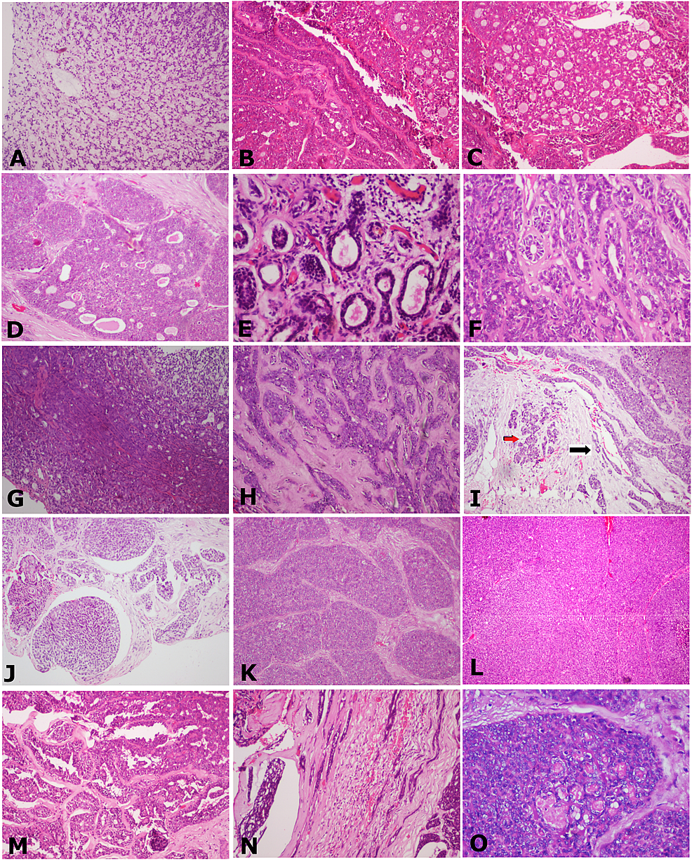 The-cells-arranged-in-various-patterns-such-as-(A)-Filigree,-H&E-staining,-x40.-(B)-Ribbon-and-cribriform,-H&E-staining,-x40.-(C)-Cribriform,-H&E-staining,-x40.-(D)-Pseudocribriform,-H&E-staining,-x40.-(E)-Ducts-and-tubules,-H&E-staining,-x100.-(F)-Tubular-pattern,-H&E-staining,-x40.-(G)-Layered-tubular,-H&E-staining,-x100.-(H)-Trabecular,-H&E-staining,-x40.-(I)-Strands-(black-arrow),-nests-and-islands-(red-arrow),-H&E-staining,-x40.-(J)-Glomeruloid,-H&E-staining-x40.-(K)-Solid-organoid,-H&E-staining,-x40.-(L)-Solid-sheet-pattern,-H&E-staining,-x40.-(M)-Papillary-cystic,-H&E-staining,-x100.-(N)-Indian-file,-H&E-staining,-x40.-(O)-Rosette,-H&E-staining,-x100.