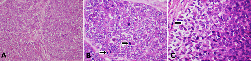 (A)-The-monotonous-tumour-cells-predominantly-showing-vesiculated-optical-clear-nuclei,-H&E-staining,-x100.-(B)-High-power-view-showing-cells-with-vesiculated-nuclei-and-mitotic-figures-(black-arrows),-H&E-staining,-x400.-(C)-Few-of-the-tumour-cells-showed-clear-cell-change-(black-arrow),-H&E-staining,-x400.