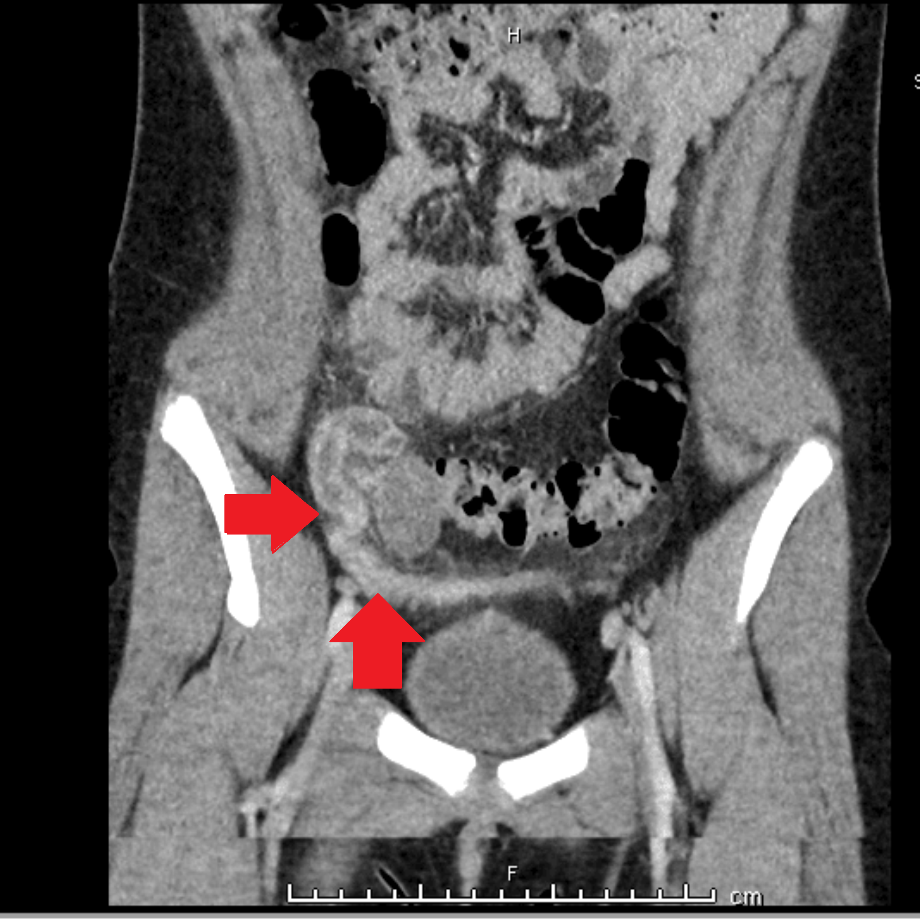 The Role of a Spinning Top Urethra in the Development of Pyosalpinx in