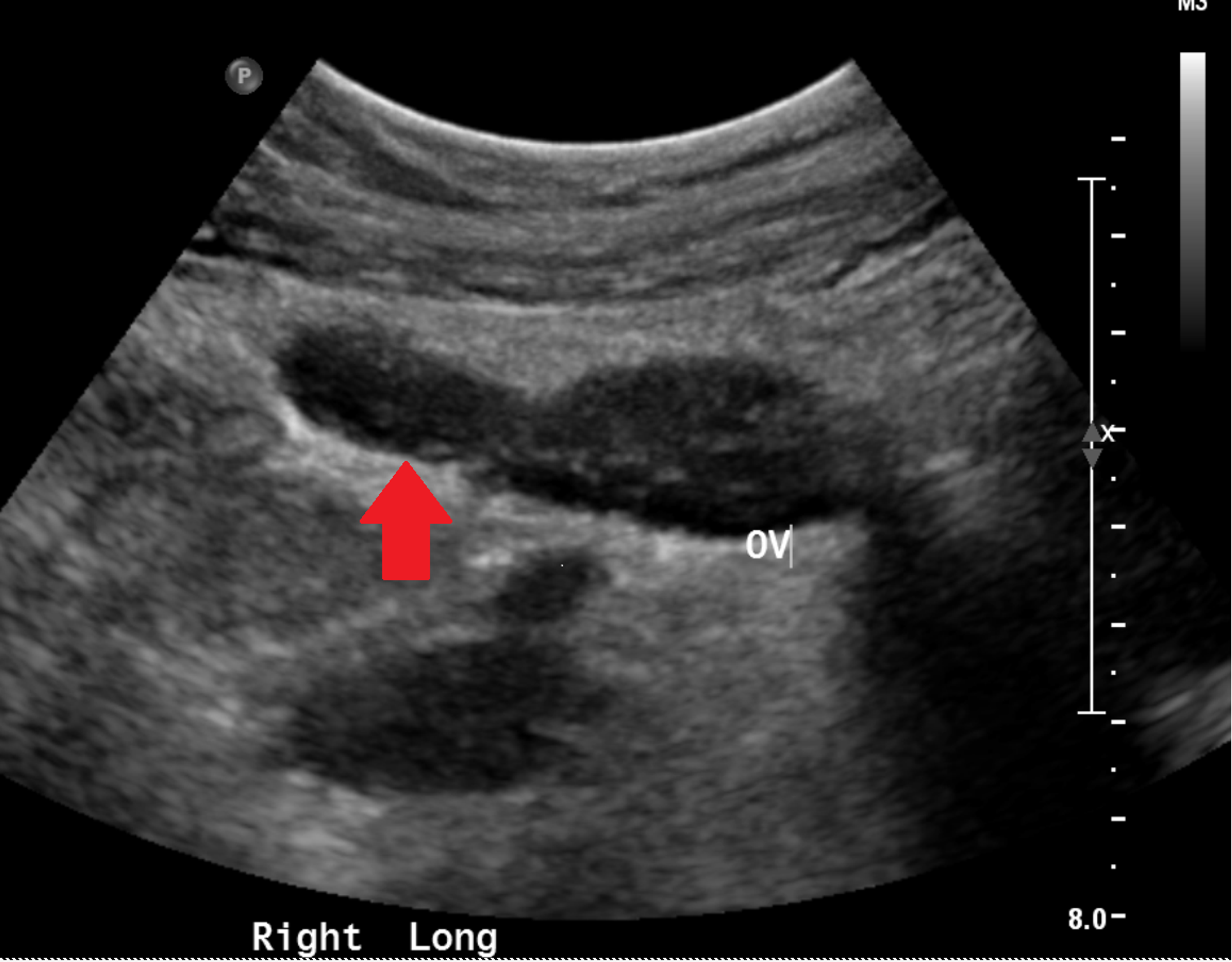Cureus The Role of a Spinning Top Urethra in the Development of