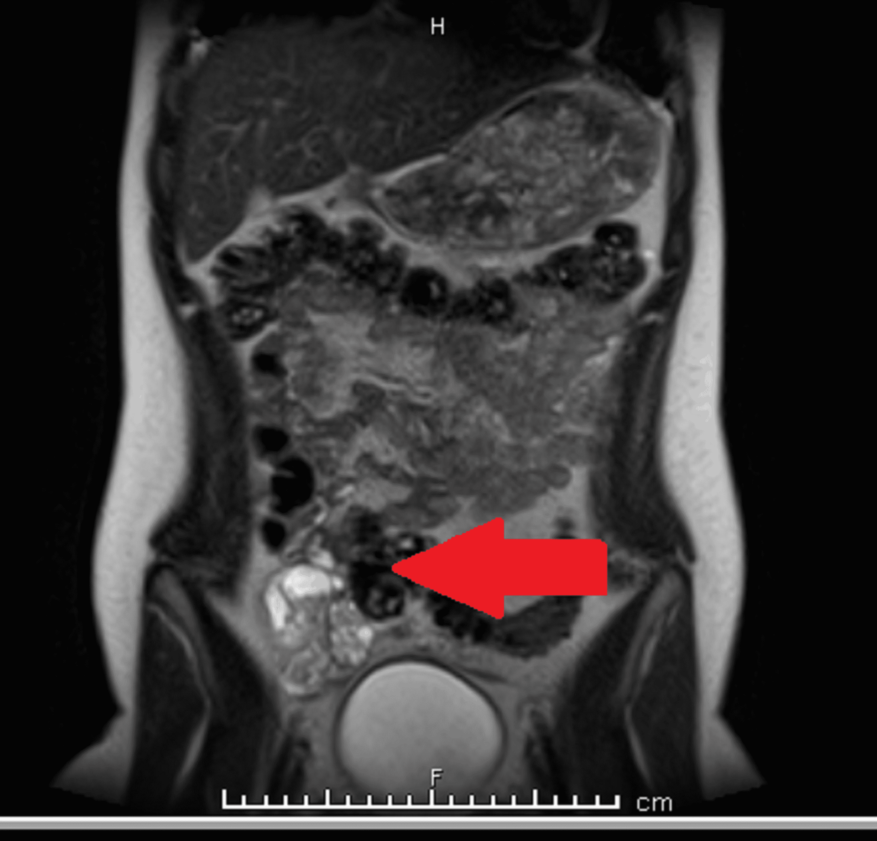 Cureus The Role of a Spinning Top Urethra in the Development of