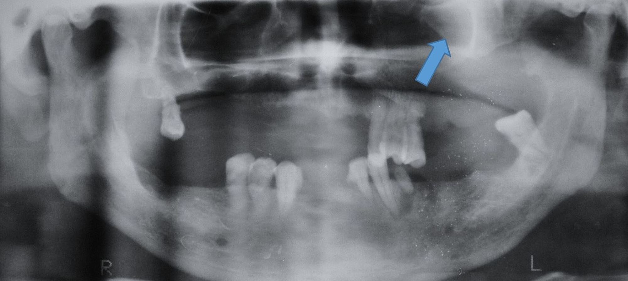 Cureus Carcinoma Of The Maxillary Antrum A Case Report