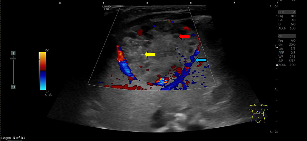 Cureus | A Case of Infantile Hepatic Hemangioendothelioma/Hemangioma at ...