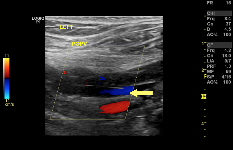 venous doppler ultrasound