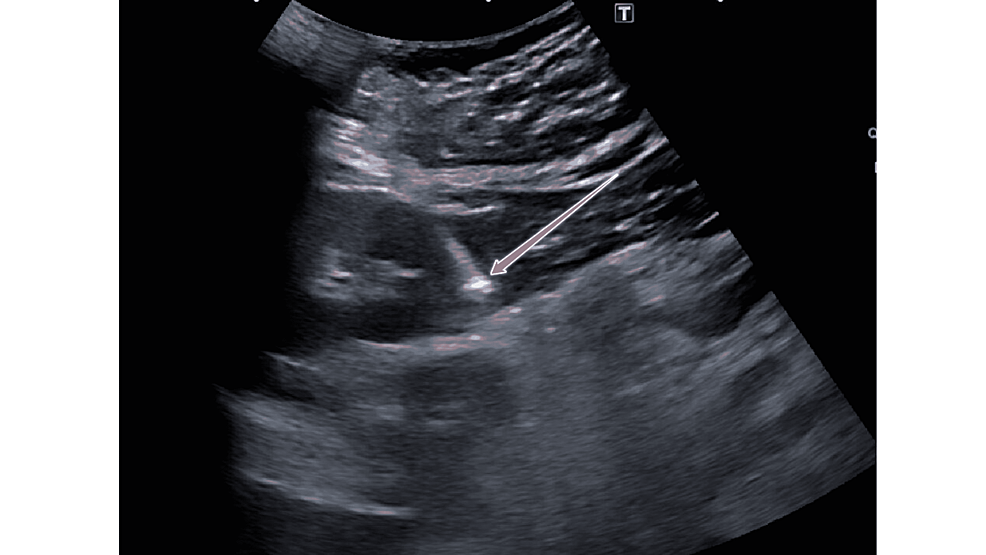 Percutaneous-biopsy-of-the-kidney-under-ultrasound-guidance.