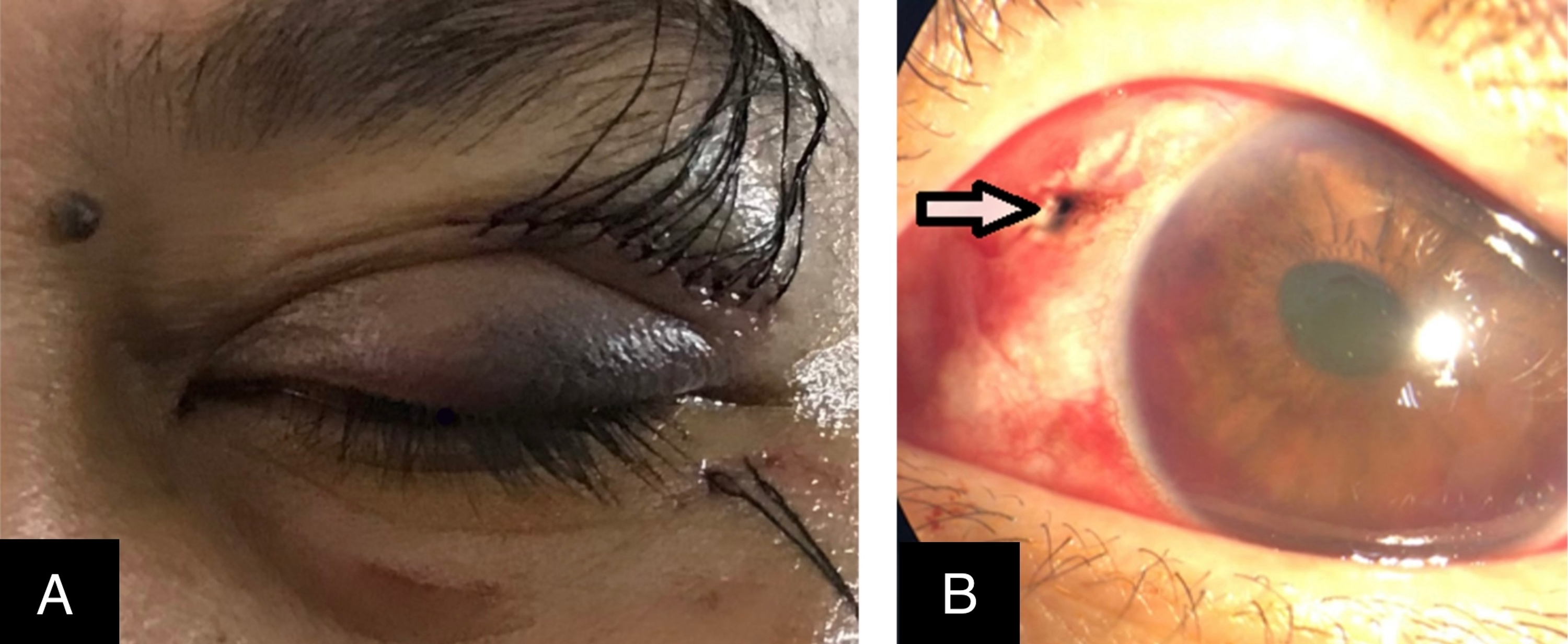 is hyphema in dogs an emergency