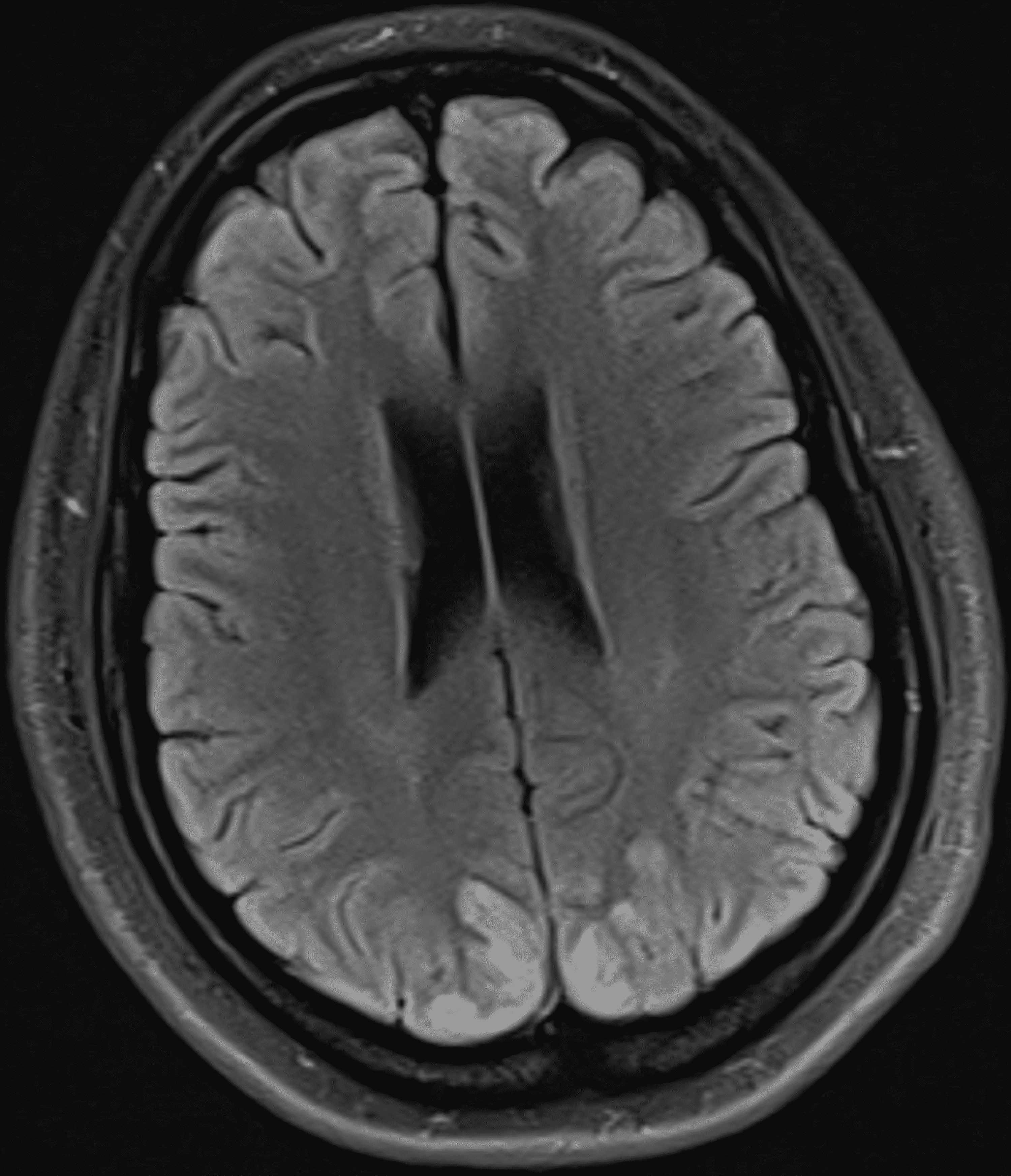 Cureus Posterior Reversible Encephalopathy Syndrome and Preeclampsia