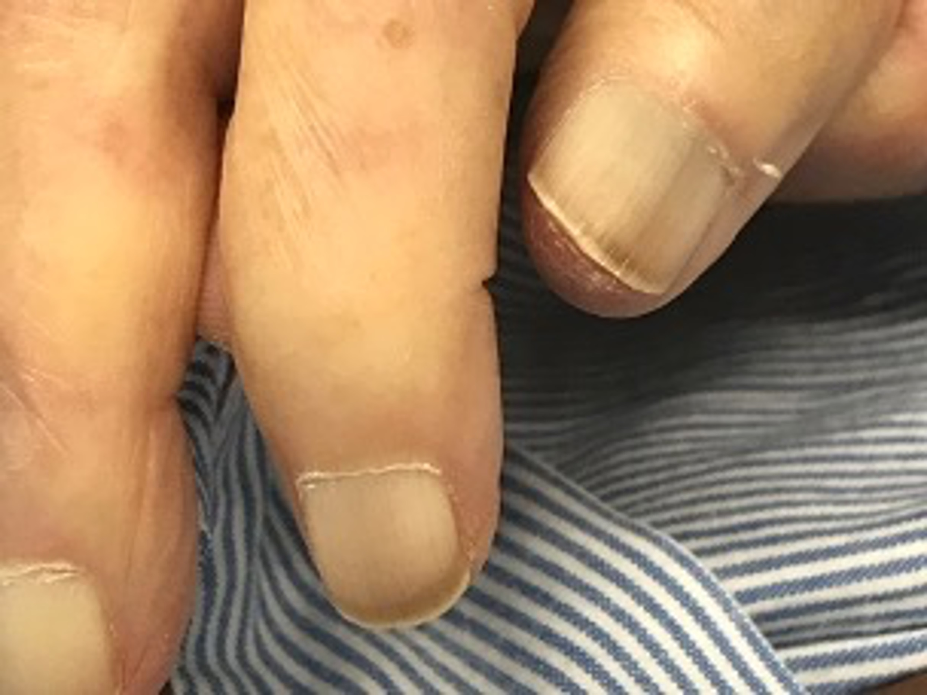 Cureus | The Relationship Between the Presence of White Nails and  Readmission Among Rural Older Admitted Patients: A Prospective Cohort Study  | Article