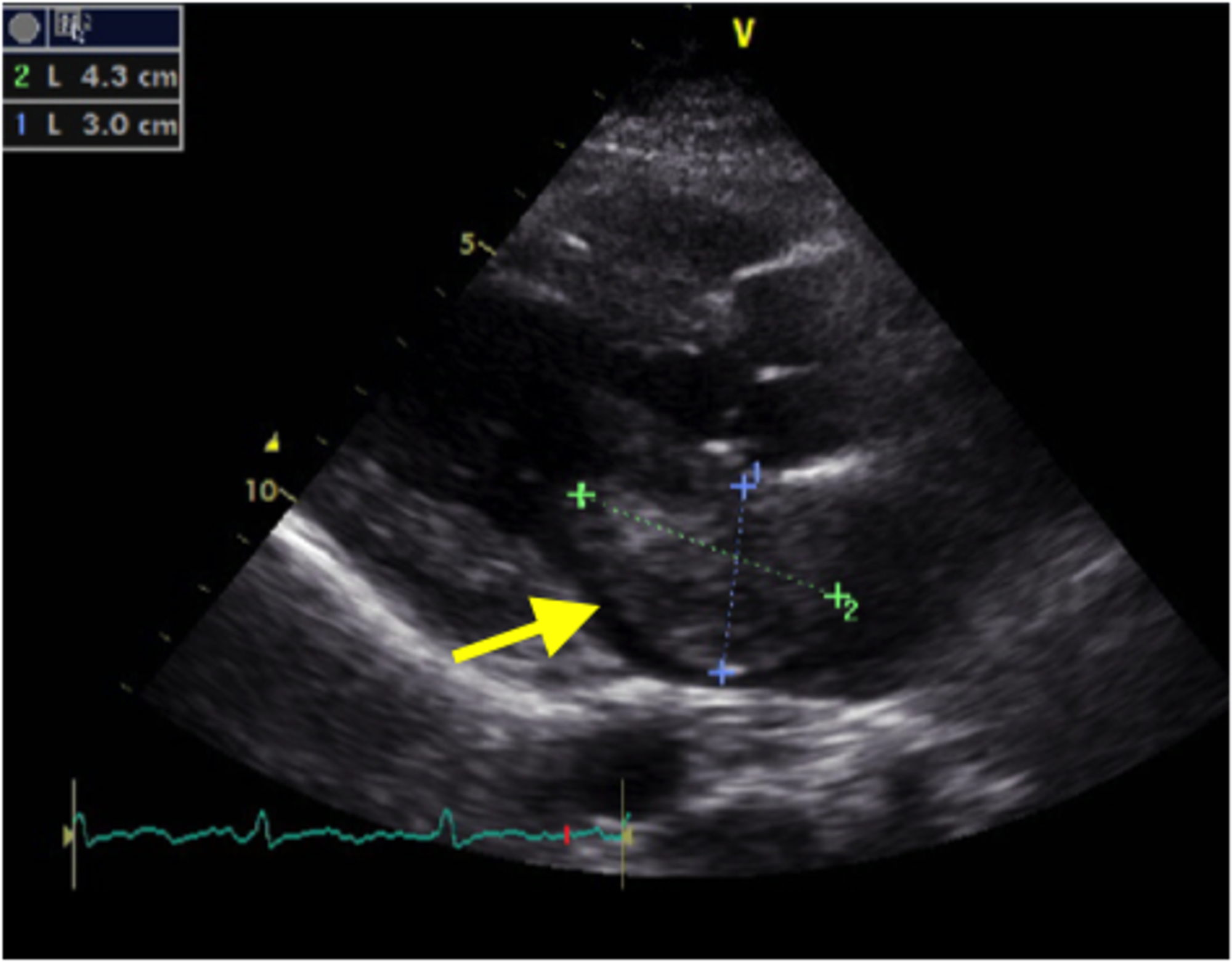 Atrial myxoma - Pictures