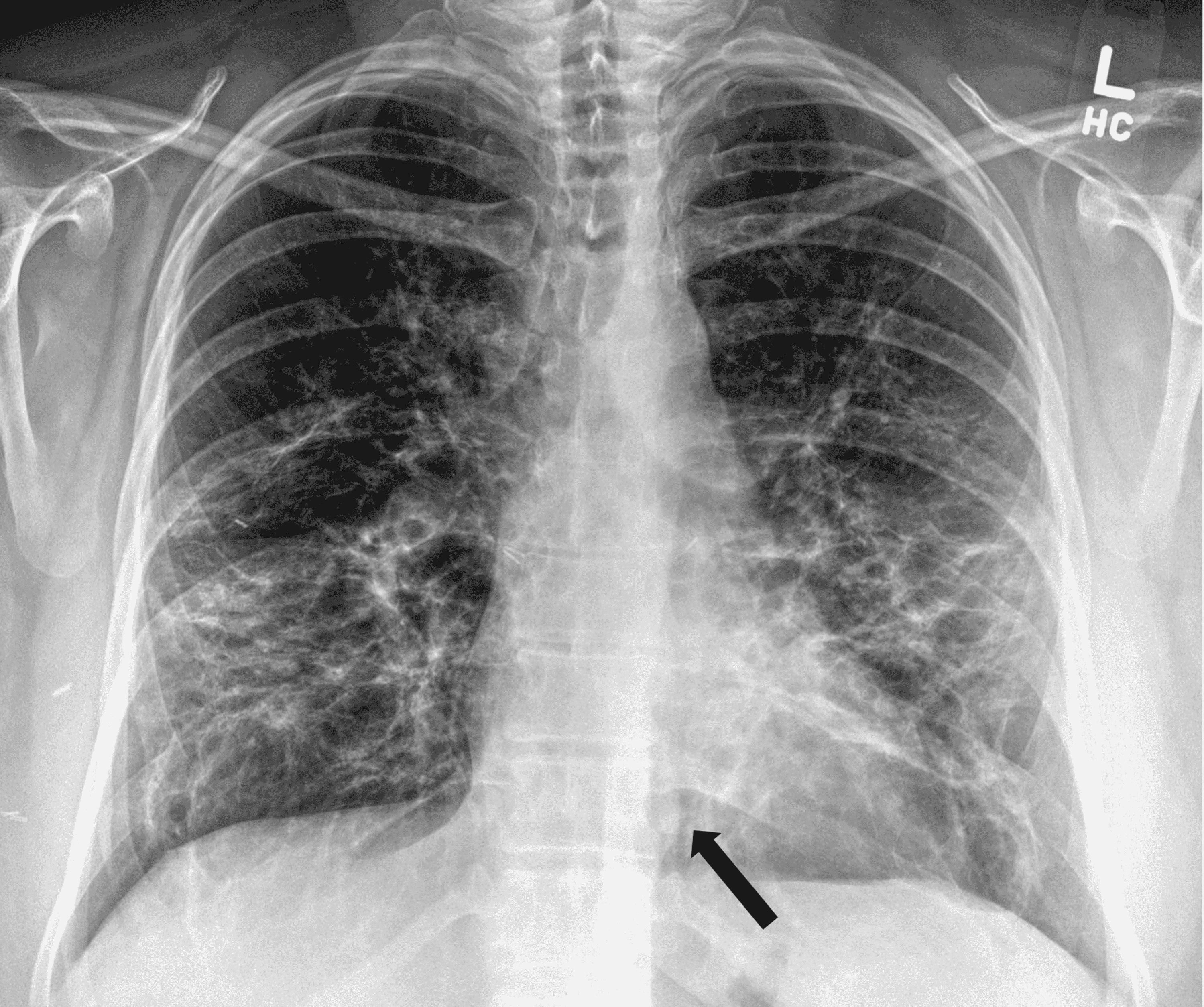 Cureus A Unique Presentation of Spontaneous Pneumomediastinum