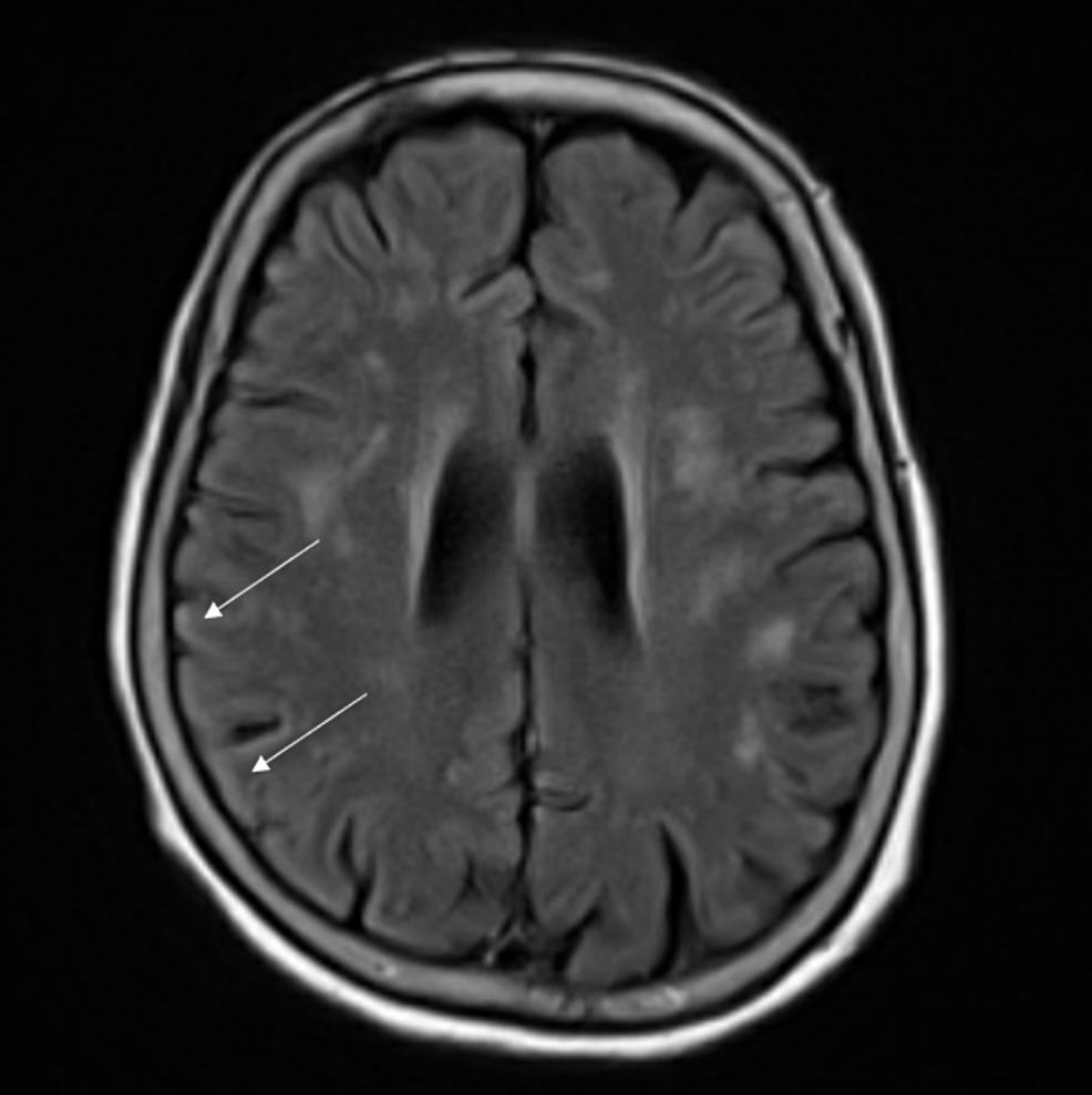 MRI-brain-scan-showing-increased-FLAIR-signal-in-the-cortical-sulci-of-the-right-parietal-lobe-(arrows).