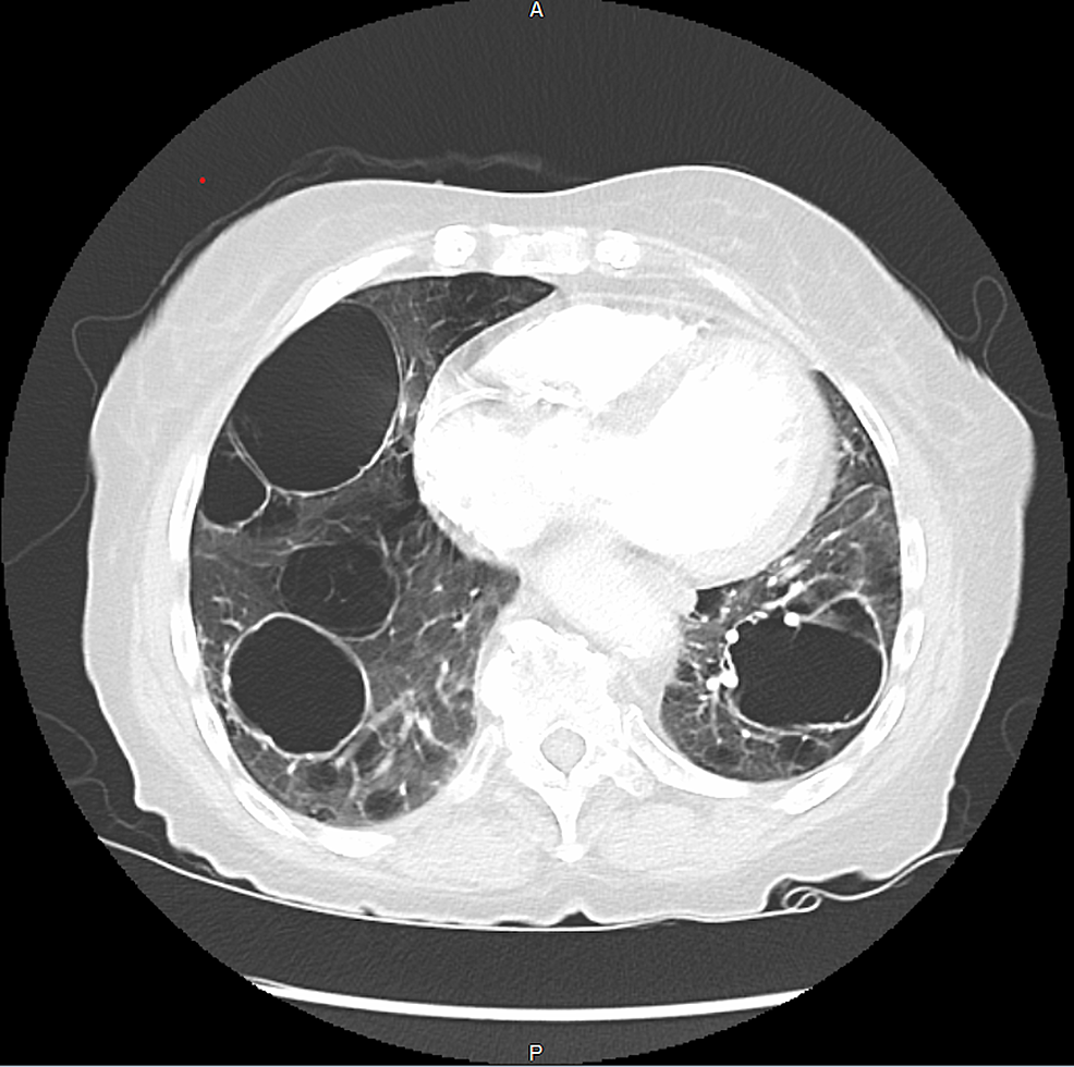 Axial-view-of-the-chest-CT-demonstrating-multiple-lung-cysts