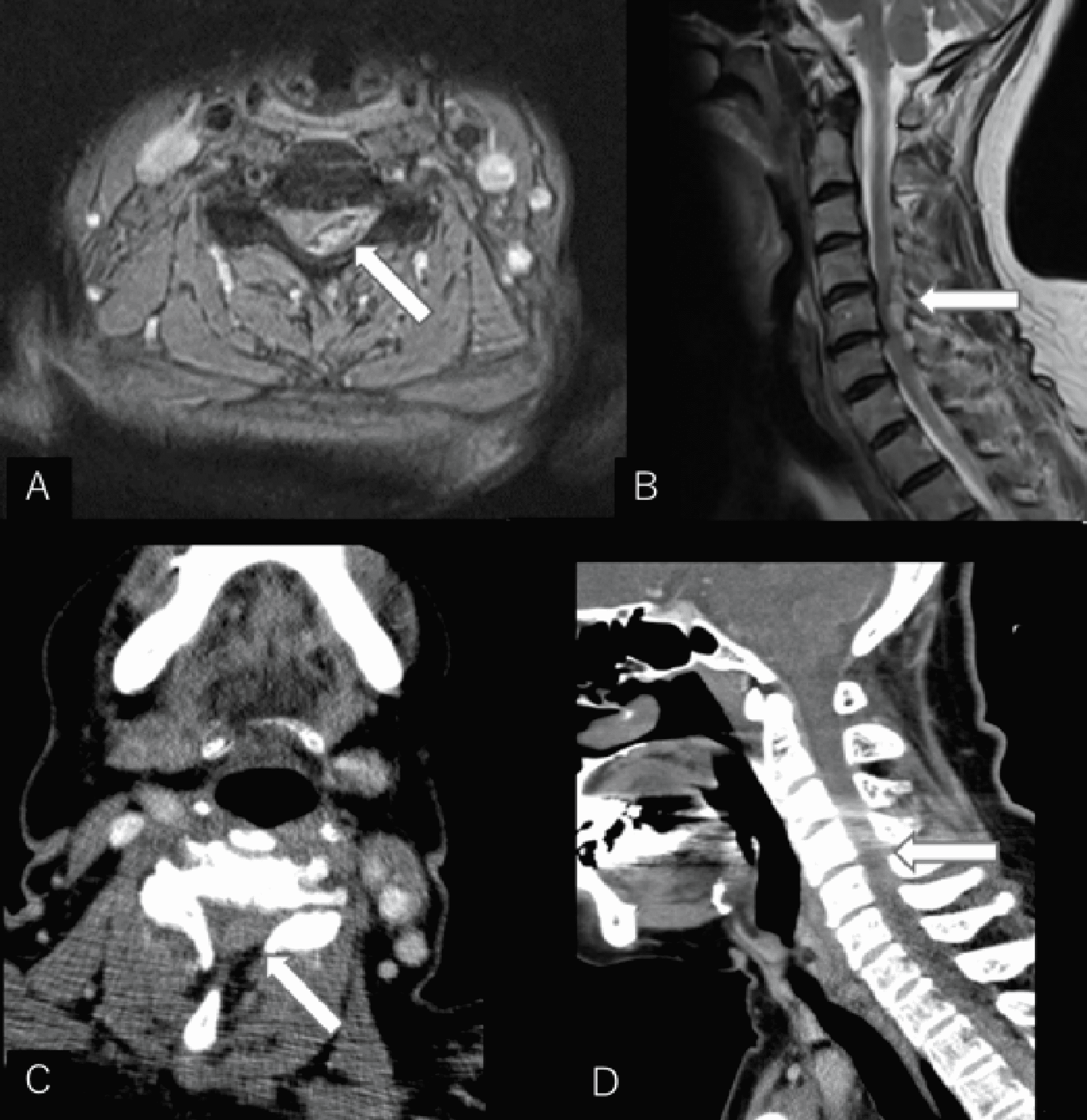 Cureus Two Cases of Cervical Epidural Hematoma Presenting With Left