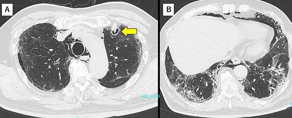 Chest-CT-findings-on-day-19