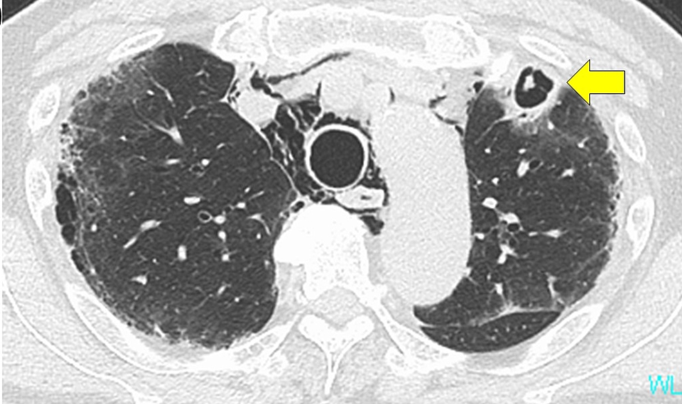 Chest-CT-findings-on-day-26