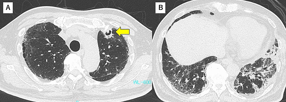 Chest-CT-findings-on-day-42