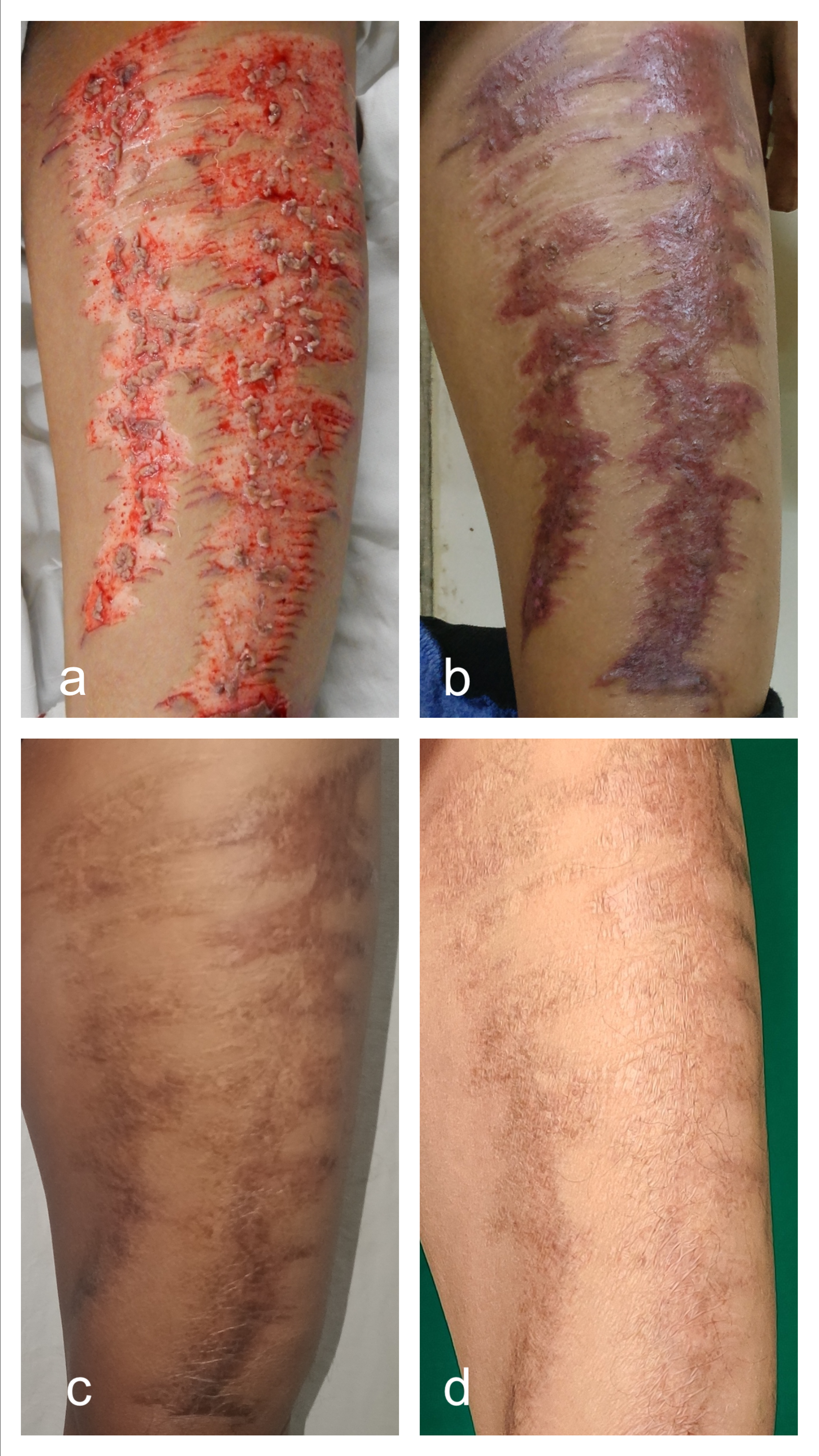 usund spansk Addiction Cureus | Use of Minced Residual Skin Grafts to Improve Donor Site Healing  in Split-Thickness Skin Grafting | Article