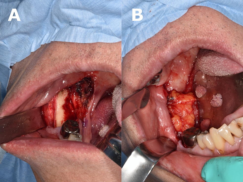 (A)-Surgical-site-after-the-tumor-resection.-(B)-Buccal-fat-pad-exposure-in-the-oral-defect.