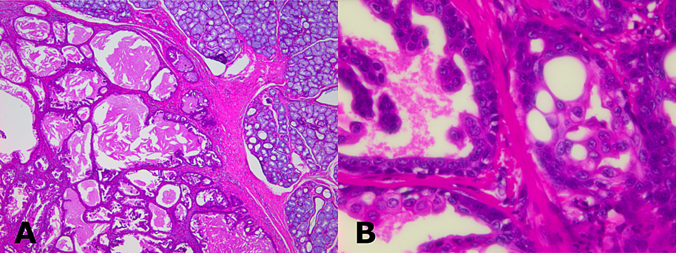 (A)-Histological-sections-showing-multiple-cystic-spaces-of-variable-sizes-with-central-eosinophilic-material-(hematoxylin-and-eosin-stain,-40x).-(B)-Cystic-cavity-lined-by-bilayered-epithelium-consisting-of-columnar-and-flat-epithelium-exhibiting-intraluminal-papillary-projections-(hematoxylin-and-eosin-stain,-400x).