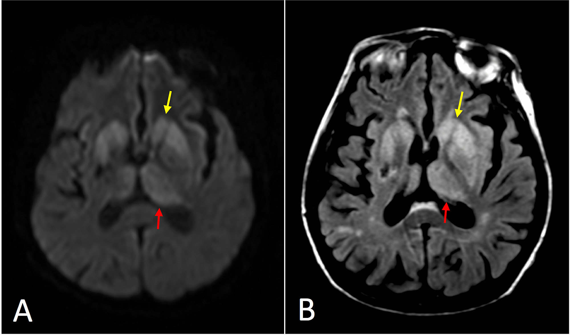 Cureus Imaging Manifestations of CreutzfeldtJakob Disease and Case