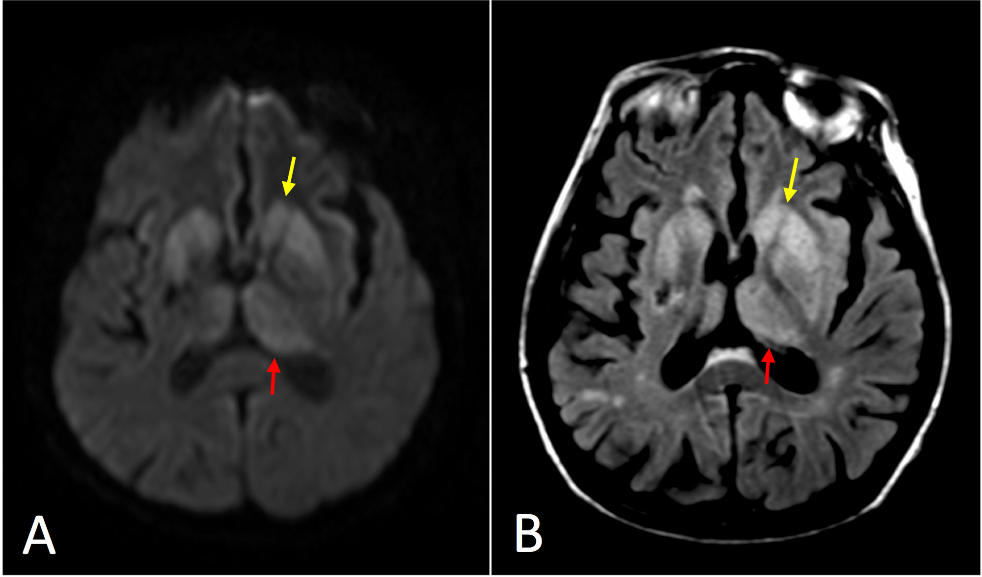 creutzfeldt-jakob-creutzfeldt-jakob-disease-stepwards-cjd-occurs