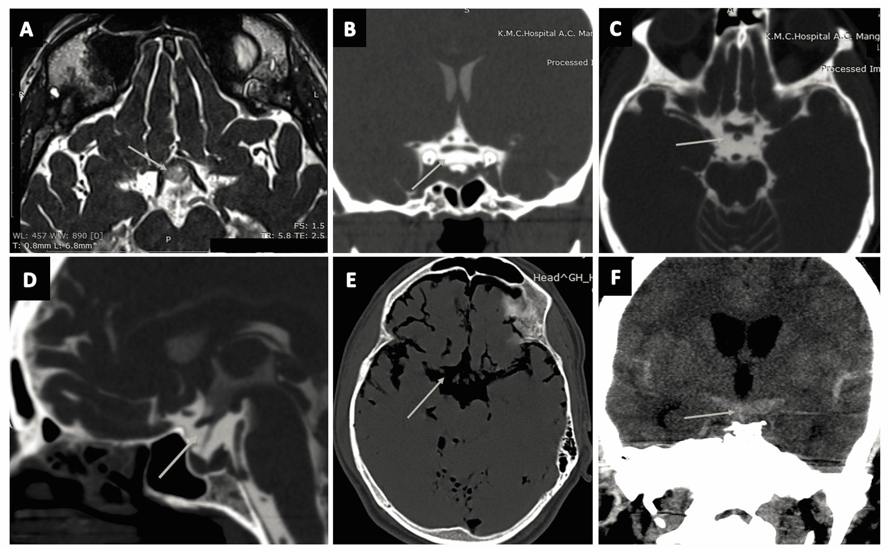 Cureus Delineation of Subarachnoid Cisterns Using CT Cisternography, CT Brain Positive and