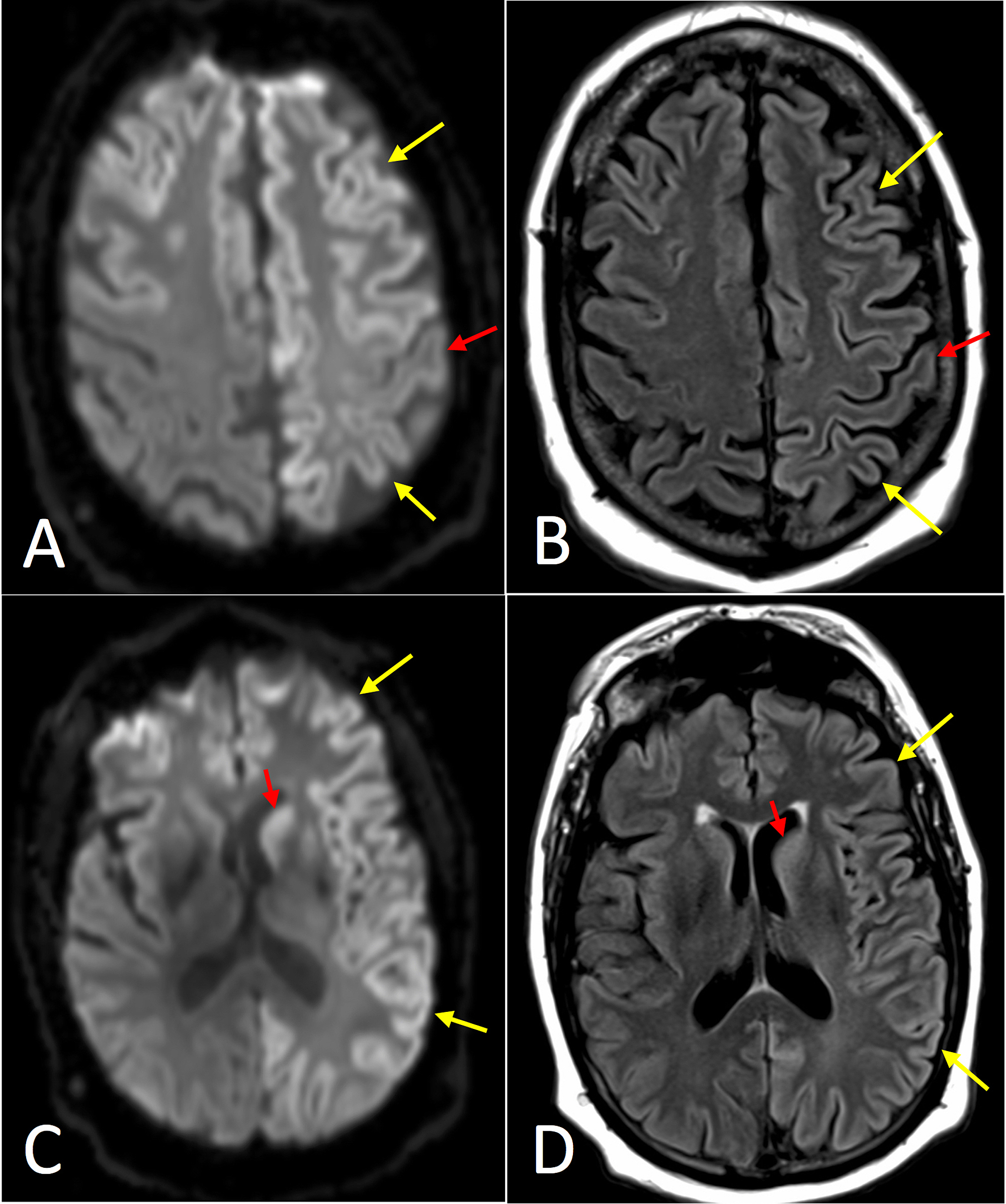 Cureus Imaging Manifestations of CreutzfeldtJakob Disease and Case