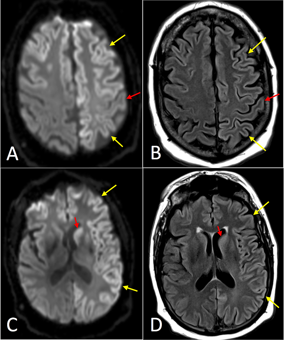 creutzfeldt-jakob-disease-cjd