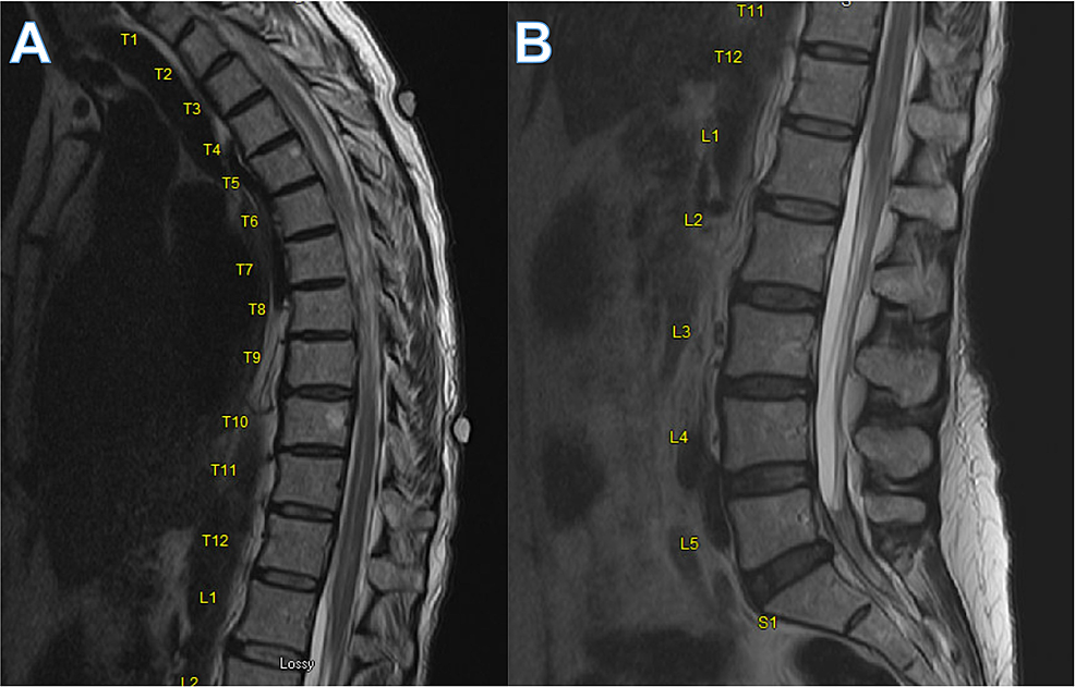 MRI-thoracic-(A)-and-lumbar-spine-(B)-demonstrating-variability-in-the-signal-of-the-spinal-fluid-at-different-levels-with-possible-arachnoid-webs-and-septation.