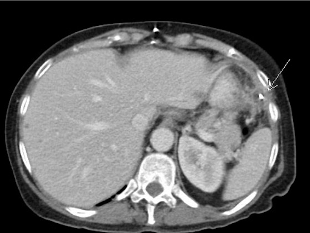 CT-abdomen-and-pelvis-with-contrast-showing-fluid-collection-hypodense-around-the-VP-shunt-denoted-with-a-white-arrow.