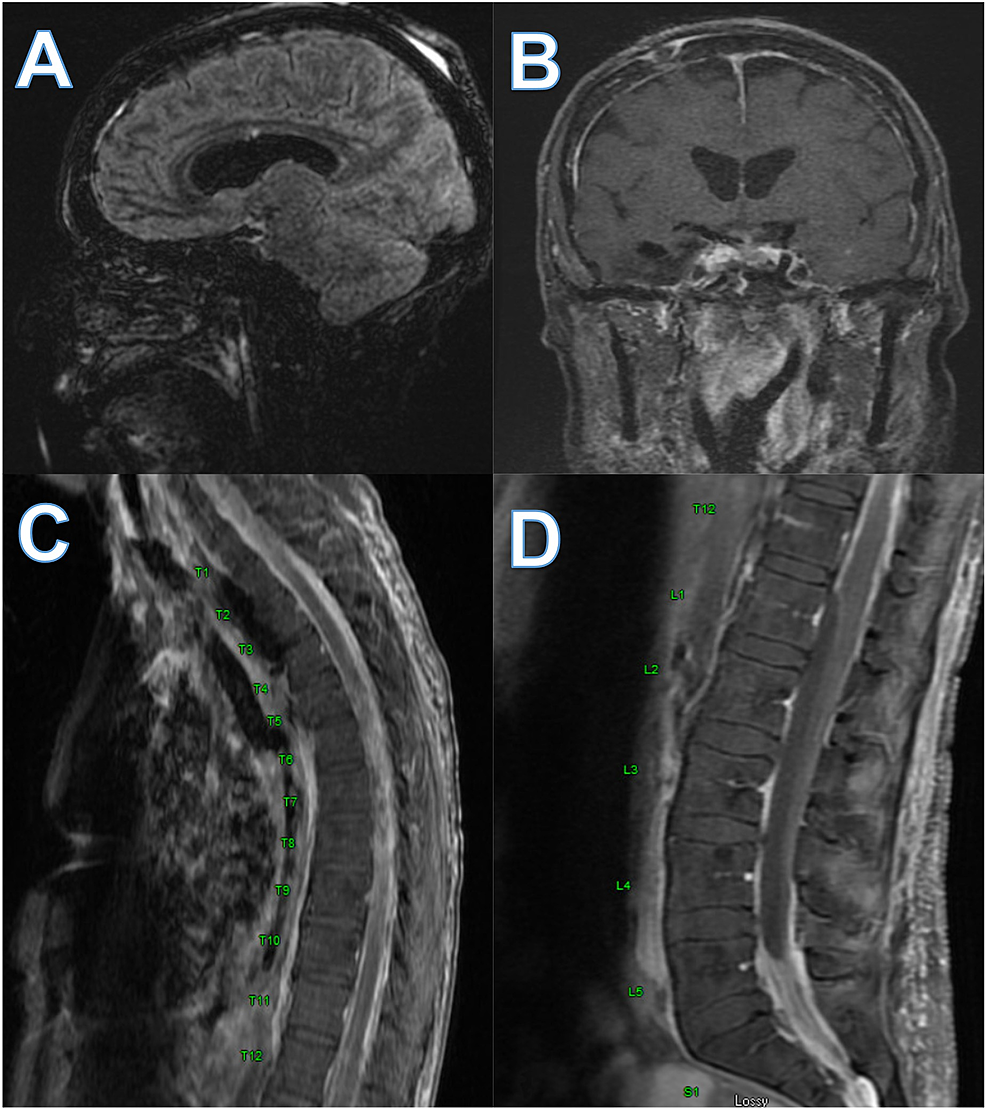 Head-MRI-and-MRI-total-spine-showing-chronic-adhesive-arachnoiditis-