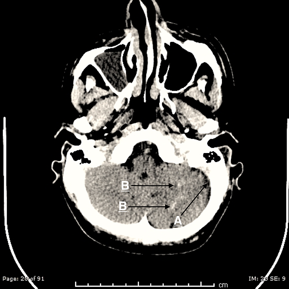 (A)-Mild-left-cerebellar-atrophy.-(B)-Left-cerebellar-curvilinear-densities-suggesting-left-cerebellar-pial-calcifications.