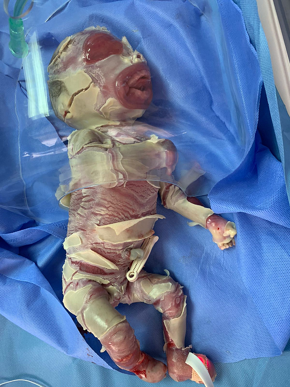 harlequin baby survivor